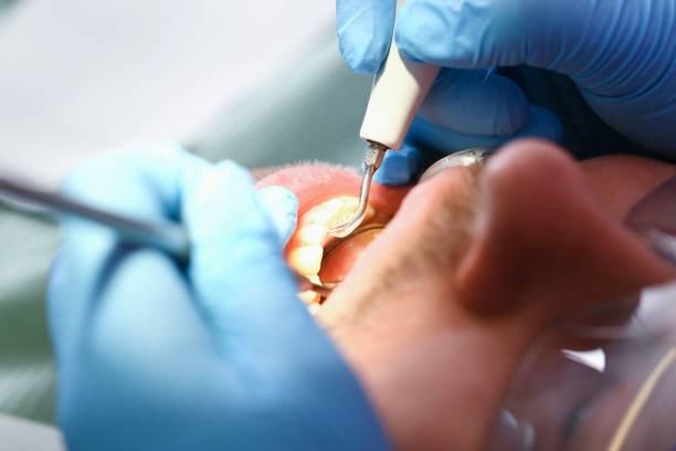 Best Dental Abscess Treatment in Beloit, KS